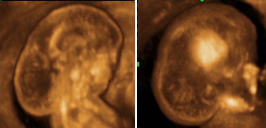 Beneficiile utilizării ecografiei 3D în diagnosticul prenatal al malformaţiilor fetale