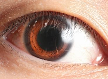 Suferi de cataractă secundară sau cunoşti pe cineva care are acest diagonistic?